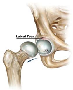 Hip Labral Repair Rehabilitation: What To Expect - Rehab Experts