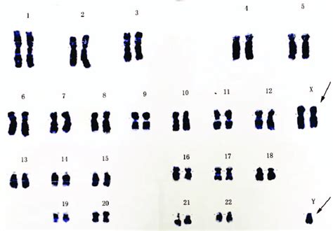 Syndromes Karyotype