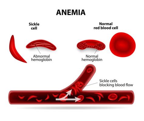 Abnormal types of hemoglobin, Sickling of RBCs, Types & causes of methemoglobinemia | Science online