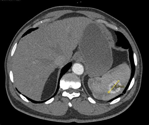 Splenic Hemangioma - Spleen Case Studies - CTisus CT Scanning