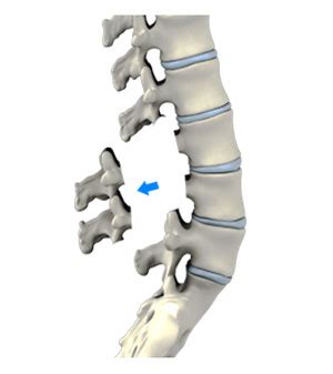 Lumbar Laminectomy Springdale, AR | Lumbar Back Pain Rogers, Bentonville, AR