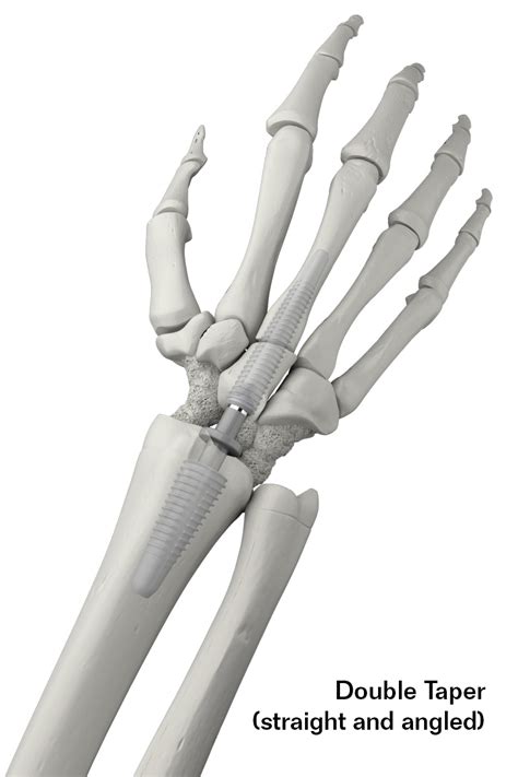 Motec Wrist Joint Arthrodesis System - Swemac