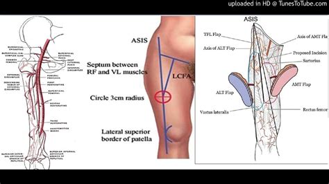 Perforator-to-perforator anastomosis: The free split anterolateral thigh (ALT) flap - YouTube