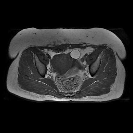 Scar endometriosis - MRI | Radiology Case | Radiopaedia.org