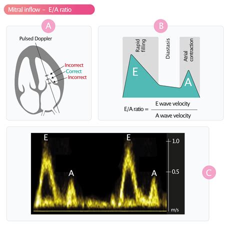 Assessment of diastolic function by echocardiography – Cardiovascular Education