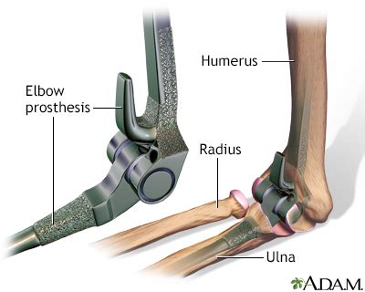 HIE Multimedia - Elbow replacement