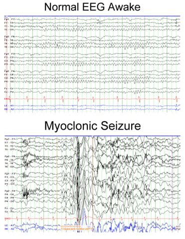 Juvenile Myoclonic Epilepsy (Janz's Syndrome) Symptoms & Treatment