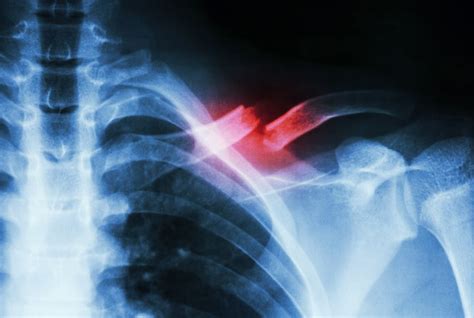 Broken Bones after a Car Accident | Bill Berenson Injury Law