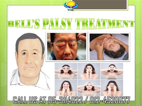 Bell's Palsy, Facial Nerve, Face Exercises, Paralyzed, Face Massage, Acupuncture, One Sided ...