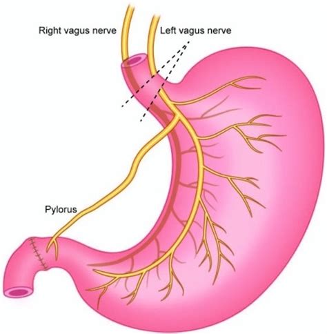 Vagotomy & Pyloroplasty - The Operative Review Of Surgery