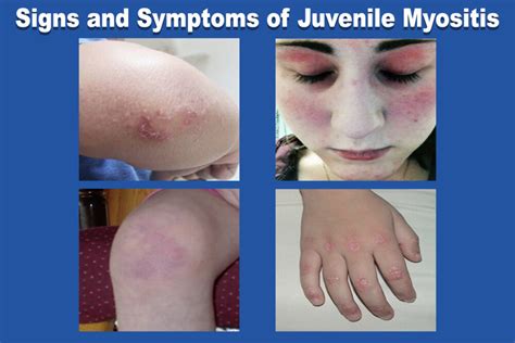 Myositis - Janise Nicholson