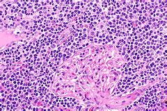 Marginal zone lymphoma - Libre Pathology