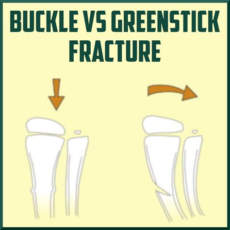 Buckle (Greenstick) Fracture of the Distal Radius - Sports Medicine Review