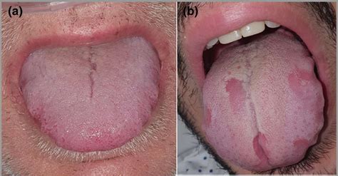 Symptoms Swollen Lips Headache | Lipstutorial.org