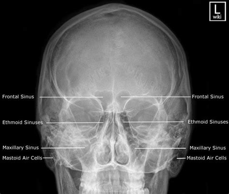 Radiographic Anatomy - Sinuses - PA 15 Caldwell | Radiographic Anatomy ...