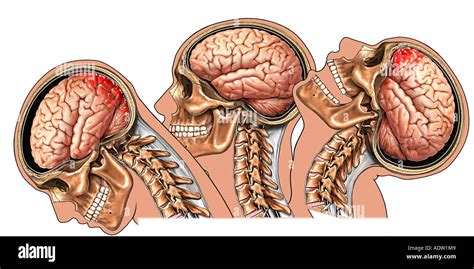 Whiplash, Closed Head Injury with Brain Stock Photo: 7711240 - Alamy