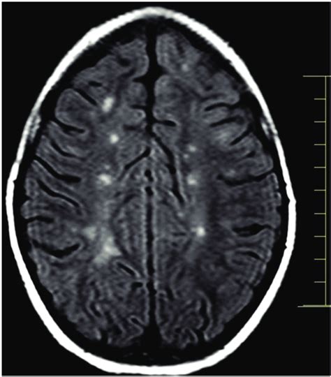 Brain Lesions Mri