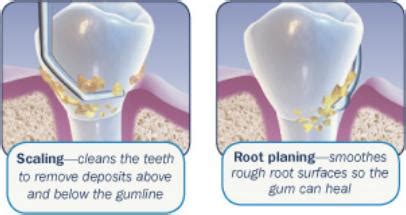 Periodontal Scaling and Root Planing | Spring Hill Dental Associates