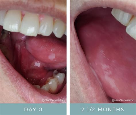 Partial Glossectomy Tongue Cancer Surgery Before + After