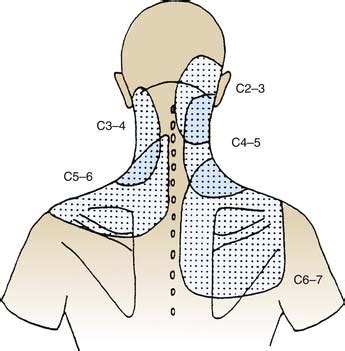 Zygapophysial Joint Pain: Procedures for Diagnosis and Treatment | Clinical Gate