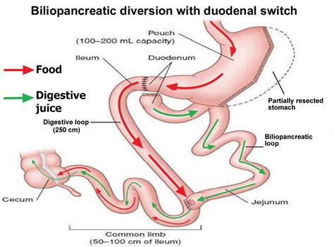 Biliopancreatic diversion with duodenal switch, side effects, complications & diet