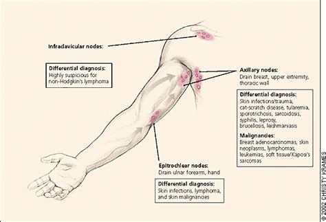 Lymphadenopathy and Malignancy | AAFP