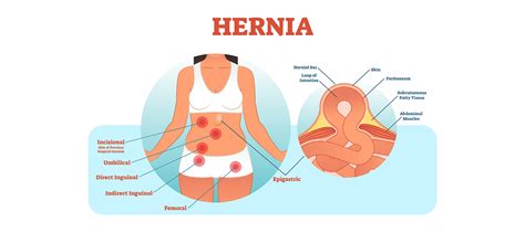 Hernioplasty: An Introduction, Procedure, Recovery, Risks & Complications | Meril Life