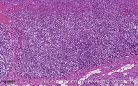 Lingual Tonsil Histology