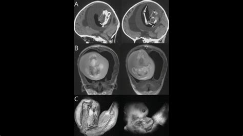 Parasitic twin found in brain of 1-year-old Chinese girl | Miami Herald