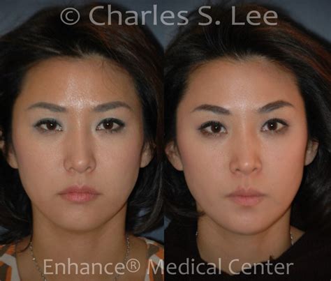 Botox Brow Lift Before And After Asian / Brow Lift Before & After ...