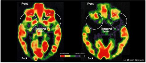 Two brain scans | MESHGuides