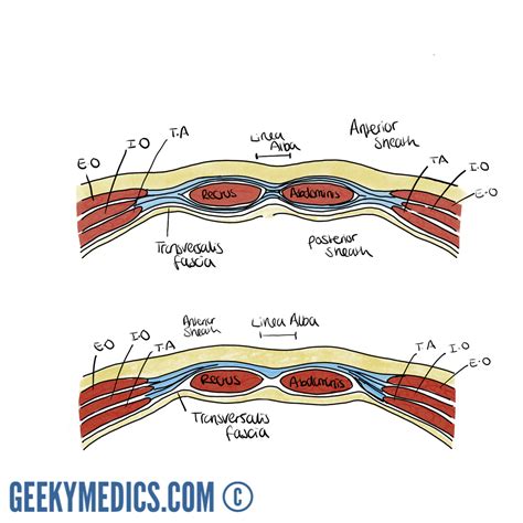 Abdominal Surgical Incisions | Gridiron | Pfannenstiel | Geeky Medics