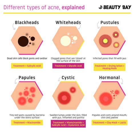 6 Different Types Of Acne, Explained - Beauty Bay Edited