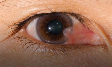 Pterygium causes, symptoms, diagnosis, treatment & pterygium eye surgery