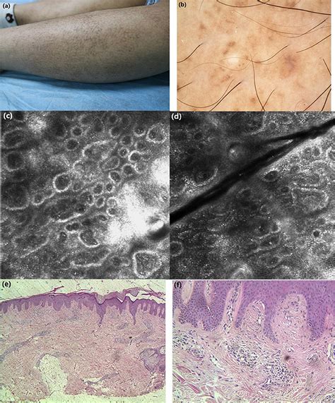 Frontiers | Case Report: Diagnosis of Primary Cutaneous Amyloidosis Using Dermoscopy and ...