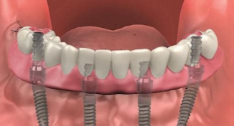 Understanding Full Mouth Dental Implants: Costs & Benefits