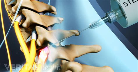 Nerve Block Injection - Amara Pain & Spine Management