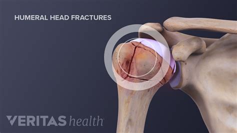 The 3 Types of Shoulder Fractures