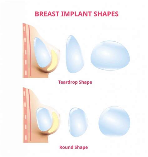 Everything You Need to Know About Breast Implant Types, different type of breast - mi-pro.co.uk