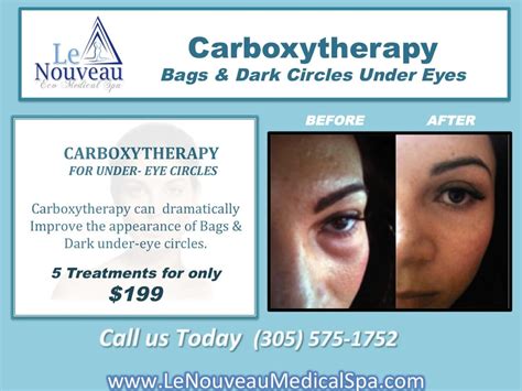 Carboxytherapy Miami, FL, Carboxytherapy for Dark circles Miami, fl. Carboxytherapy for under ...