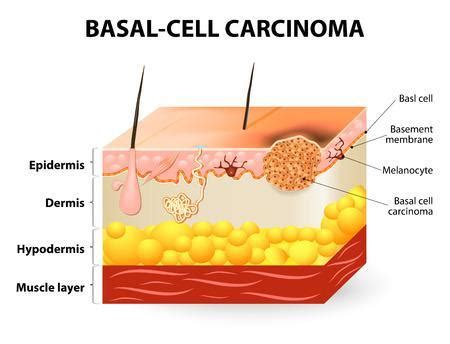 Basal Cell Carcinoma Treatment Options: HK Dermatology: Dermatology Clinic