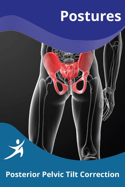 Posterior Pelvic Tilt Correction – EasyFlexibility