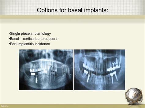 The techniques of basal implants