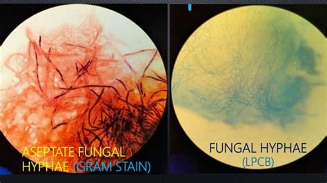 Fungal Corneal Ulcer Ophthalmology PPT.pptx