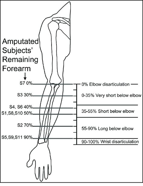 Remaining forearm percentage of subjects with amputation. S = subject ...