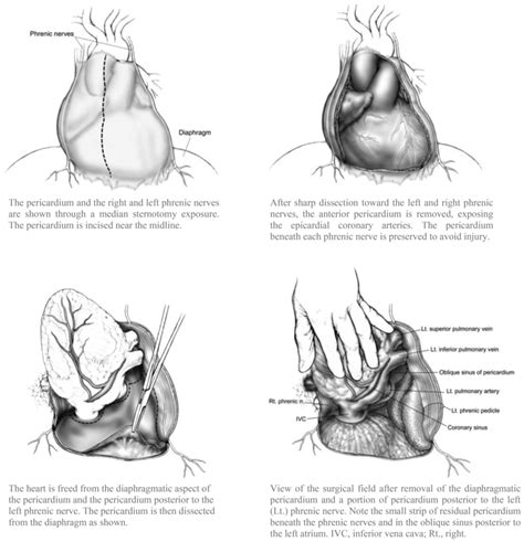 Schematic representation of radical pericardiectomy via median... | Download Scientific Diagram