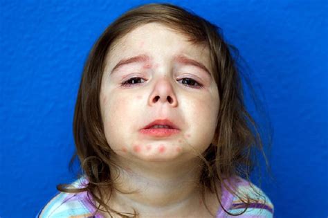 Causas y tratamiento de la psoriasis infantil | Madres Hoy