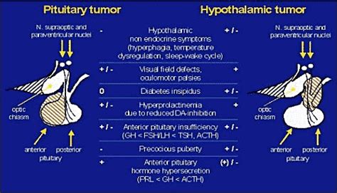 Pituitary-Hypothalamic Tumor Syndromes: Adults - Endotext - NCBI Bookshelf