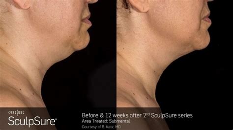 SculpSure before and after Photos: Real Patient Results - New Beauty ...