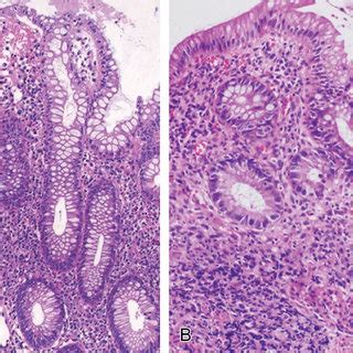 Gross features of UC: erythematous mucosa with a cobblestone appearance... | Download Scientific ...